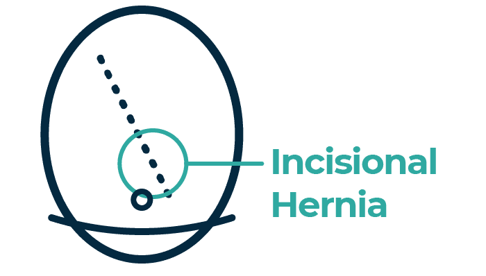Hernia repair surgery in Leeds
