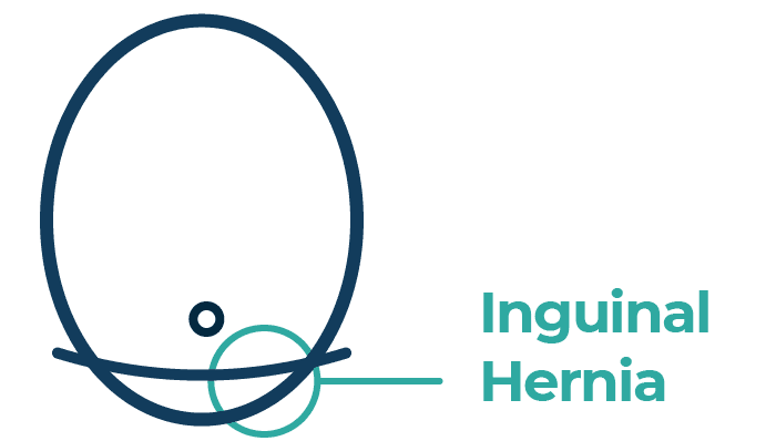 Hernia repair surgery in Leeds