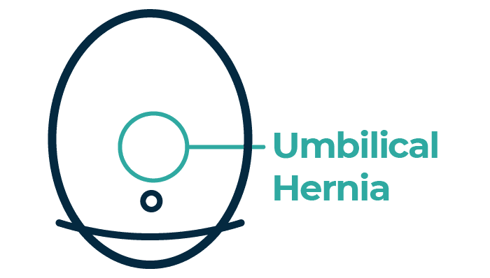 Hernia repair surgery in Leeds